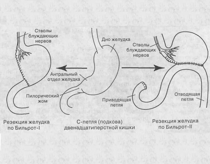 Операция по Бильрот 1 и 2 схема. Операция Бильрот 2 схема. Отличия резекции желудка Бильрот 1 и 2. Операция по Бильрот 1 техника. Без желудка после операции