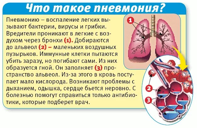 Можно ли лечить пневмонию. Пневмония процесс заболевания. Воспалительный процесс в легких.