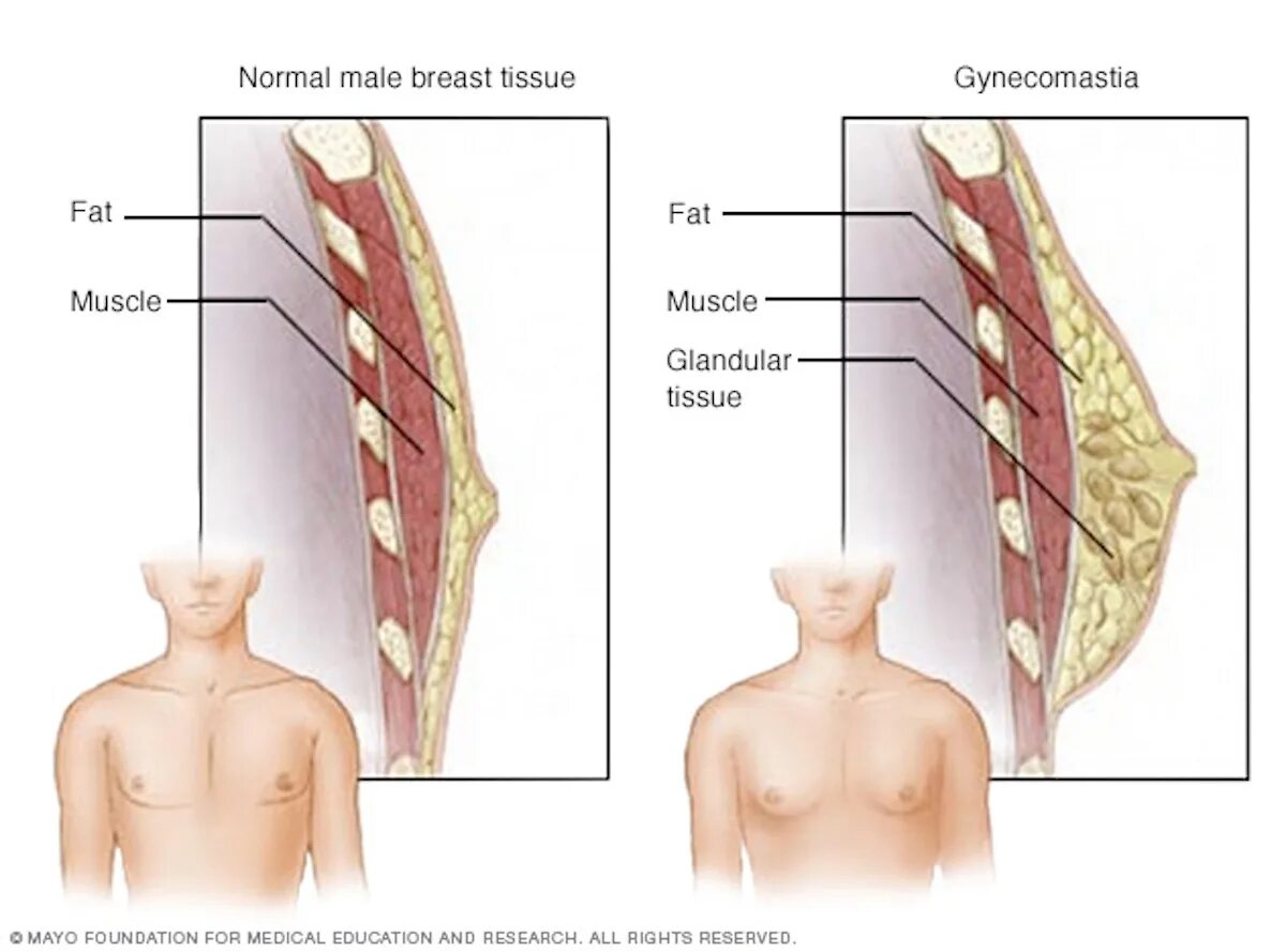 Печень и молочные железы. Что такое гинекомастия грудных желез у мужчин. Железистая ткань гинекомастии у мужчин. Молочная железа у мужчин.