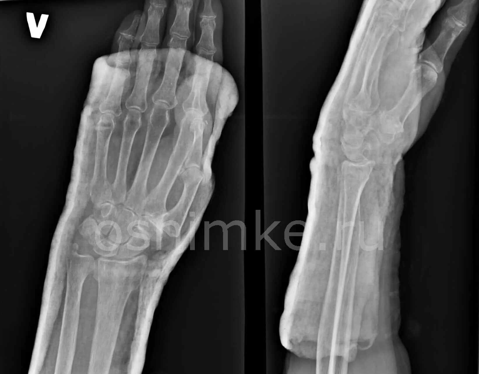 рентгенограмма перелом кости. повторный рентген при переломе. перелом смита и колеса рентген. перелом левой руки рентген. гематома перелом 5 ой плюсневой кости.