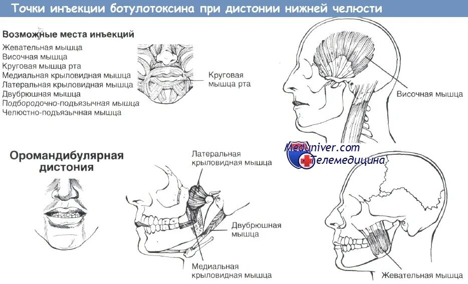 Укол точка голода отзывы. Ботулинотерапия при оромандибулярной дистонии. Схема лица для ботулинотерапии. Ботулинотерапия нижней трети лица схемы.