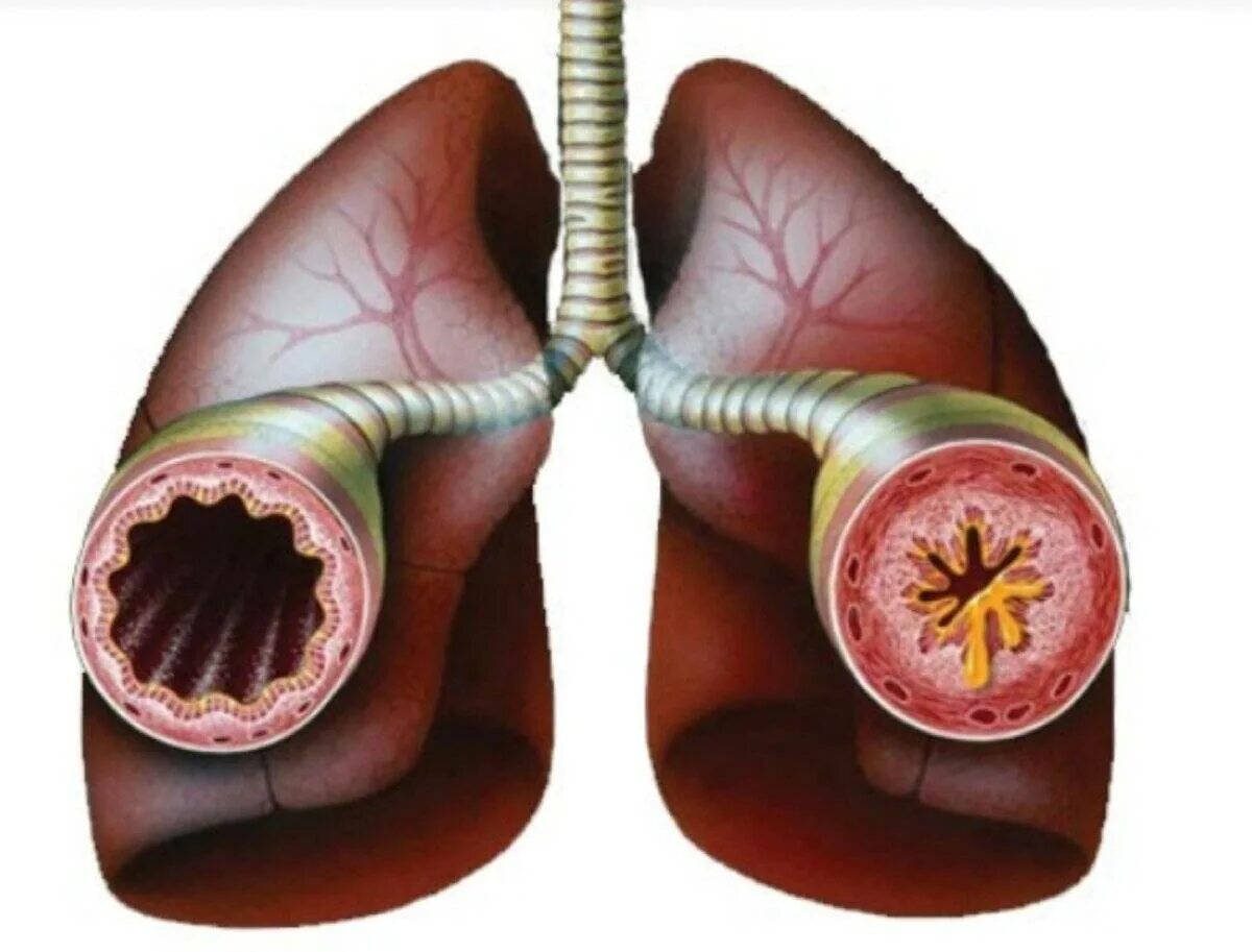 Бронхит у человека. Бронхиальная астма бронхоспазм. Бронхиальная астма и хронический бронхит. Острый бронхит бронхиальная астма у детей. Бронхит астма.