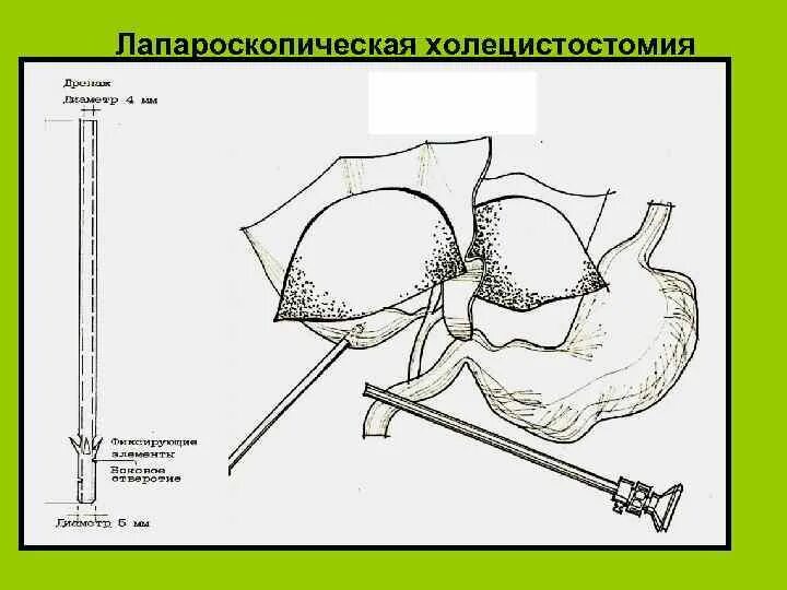 Подтягивание матки. Холецистостомия лапаротомная. Холецистостомия и холецистэктомия. Лапароскопическая холецистостомия. Лапароскопическая холецистостомия техника.