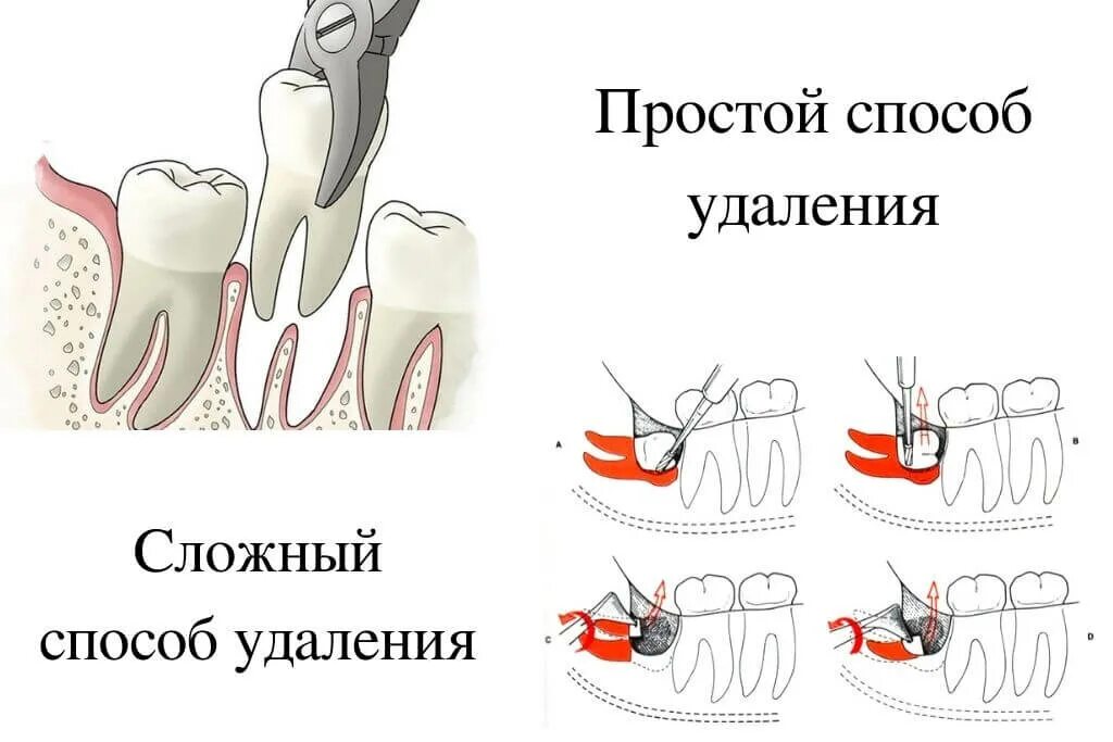 Сложное удаление зуба. Как удаляют зуб мудрости. Технология вырывания зуба. Удаление зубов мудрости этапы.