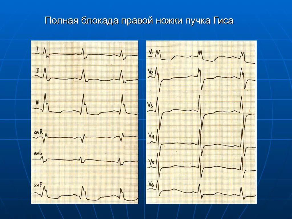 Гиса блокада пнпг. Блокада правой ножки пучка Гиса на ЭКГ что это на ЭКГ. Блокада правой ножки пучка Гиса на кардиограмме. Кардиограмма блокада правой ножки пучка Гиса на ЭКГ. ЭКГ полная блокада правой ножки п.Гиса.