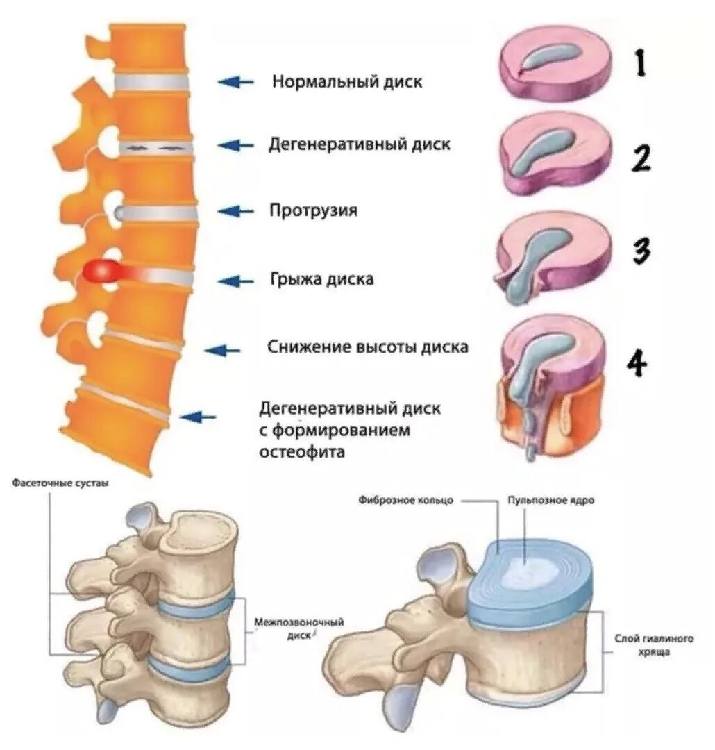 Межпозвоночные диски l5 l6. Межпозвонковые диски l2,l3, l4. Протрузия диска l1-s1. Грыжа позвоночного диска l5/s1. Можно ли греть грыжу позвоночника