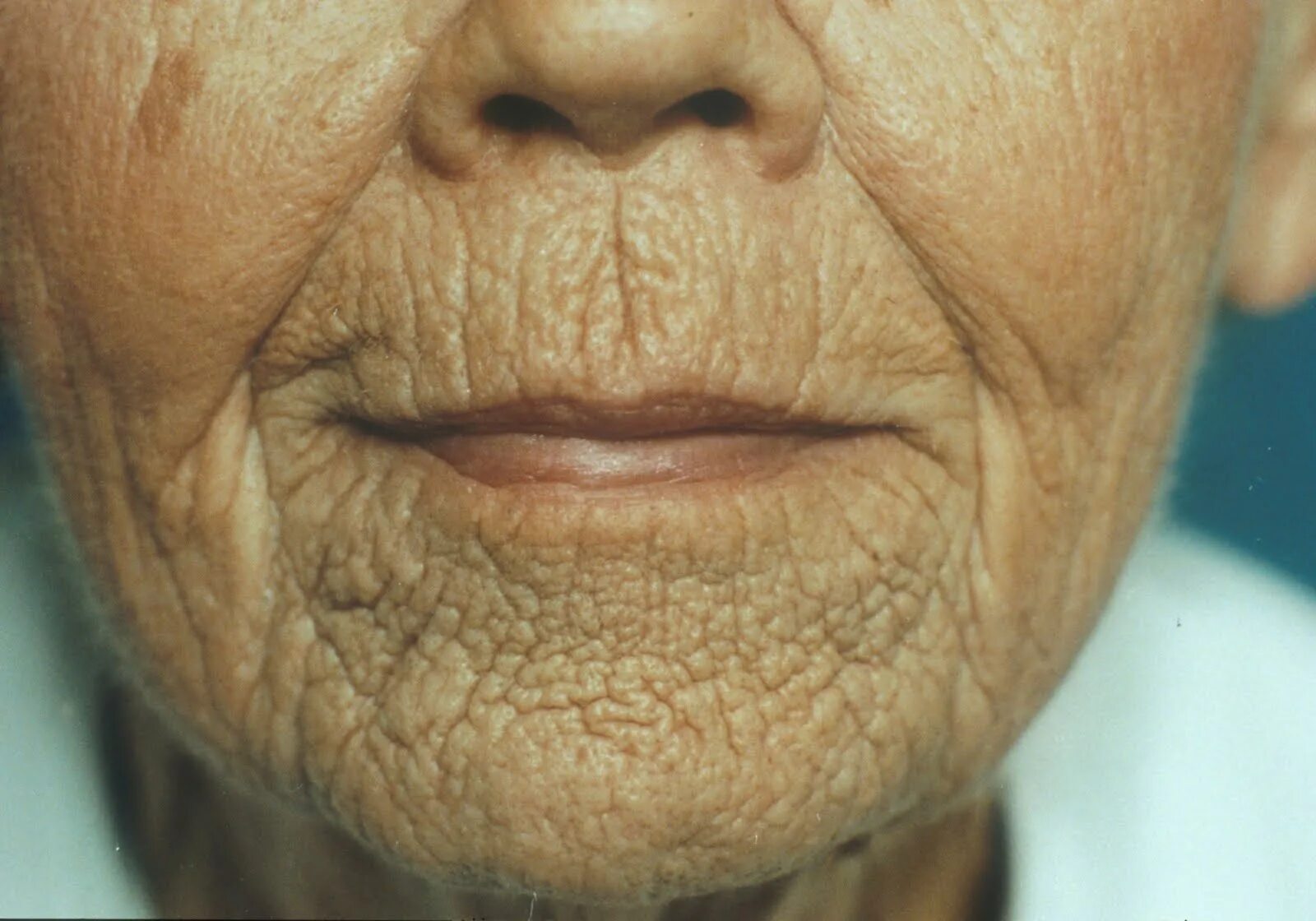 Старческие морщины. Skin wrinkles