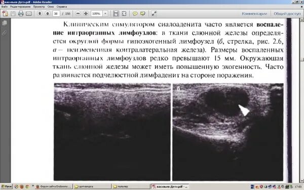 Протокол УЗИ слюнной железы сиалоаденит. Сиалоаденит УЗИ картина. Поднижнечелюстная слюнная железа УЗИ. УЗИ подчелюстной слюнной железы протокол. Узи околоушной железы