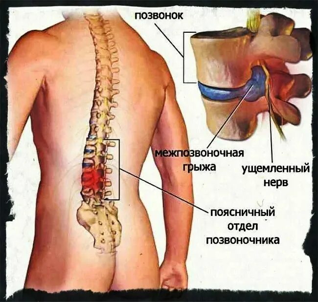 Удар поясницей. Грыжа позвоночника. Спинная грыжа. Ушиб поясничного позвонка. Сильный ушиб позвоночника.