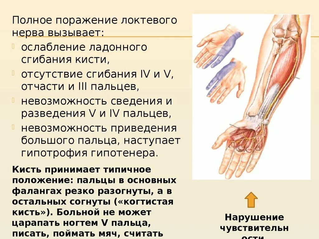 Нейропатия локтевого нерва клиника. Невропатия локтевого нерва симптомы. Поражение сенсорных волокон нервов верхних конечностей. Поражение локтевого нерва руки.