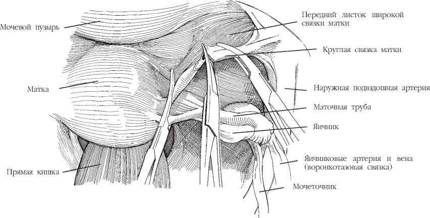 Связка подвешивающая яичник. Круглая связка матки. Воронко тазовая связка матки. Круглая связка матки расположение. Связочный аппарат матки.