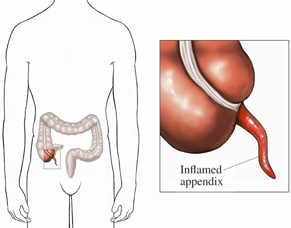 Как определить аппендицит у мужчины. Схема органов человека аппендицит. Воспалённый аппендицит симптомы. Расположение аппендицита у человека. Печеночный аппендицит.