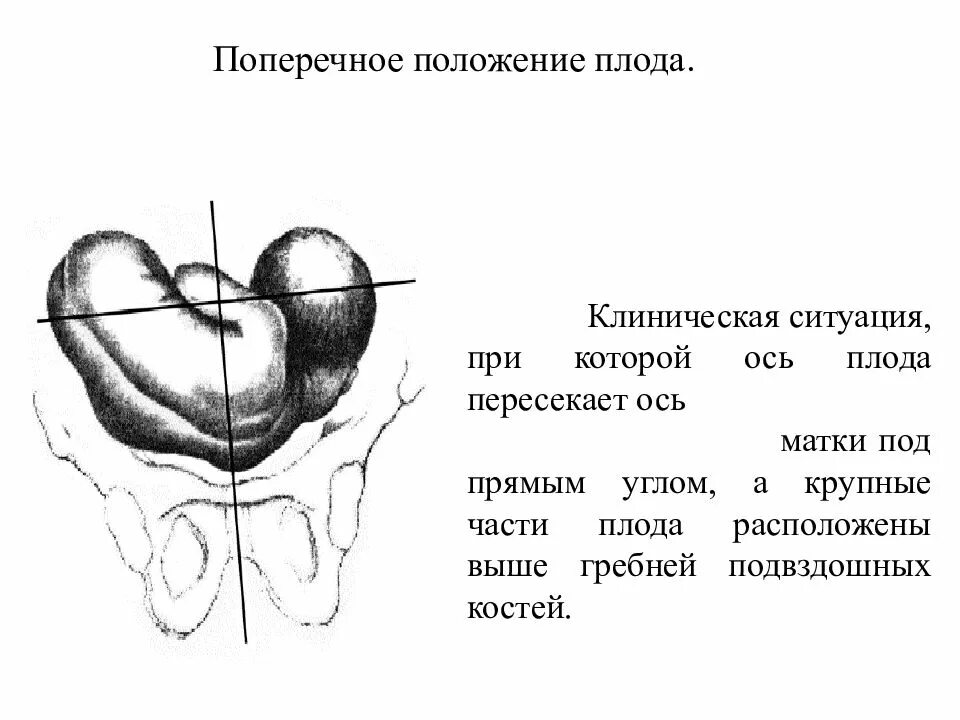 Позиция плода при поперечном положении. Поперечное и косое положение плода УЗИ. Косое положение плода позиция. Поперечное положение плода в 30. Продольное и поперечное положение.