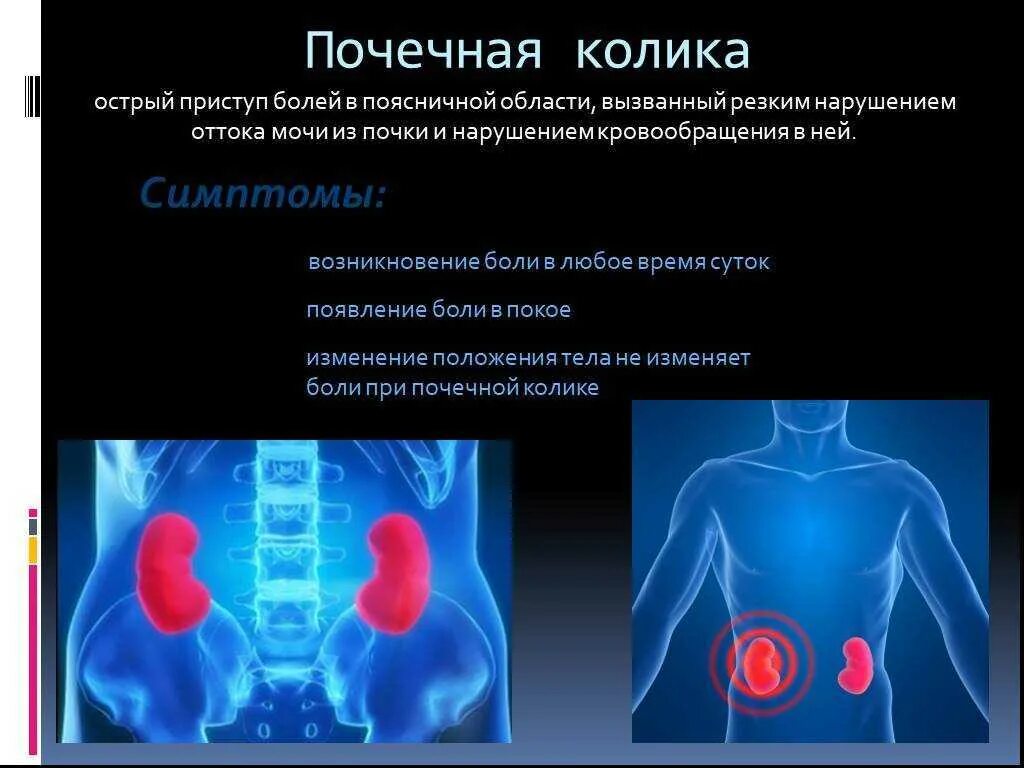 Колики в районе. Острая почечная колика локализация боли. Почечная колика при мочекаменной болезни. Почечная колика локализация болей. Локализация боли при почечной колике.