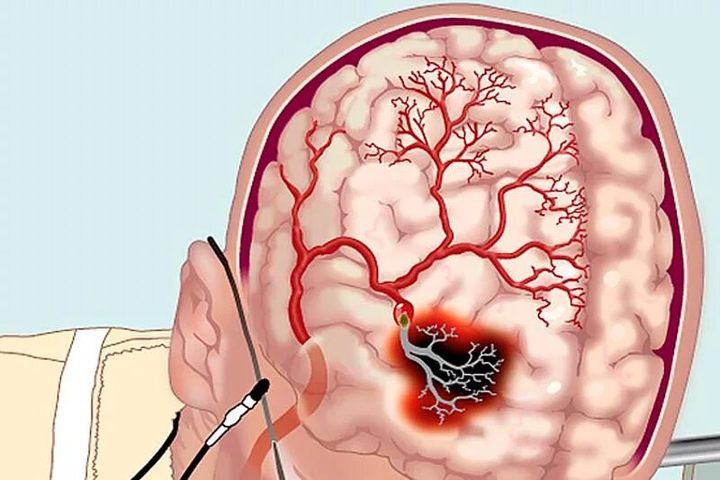 Церебральная ангиодистония что это. Атеросклероз артерий головного мозга макропрепарат. Атеросклероз сосудов головного мозга макропрепарат. Сосудистые заболевания головного мозга ОНМК. Инсульт острое нарушение мозгового кровообращения.