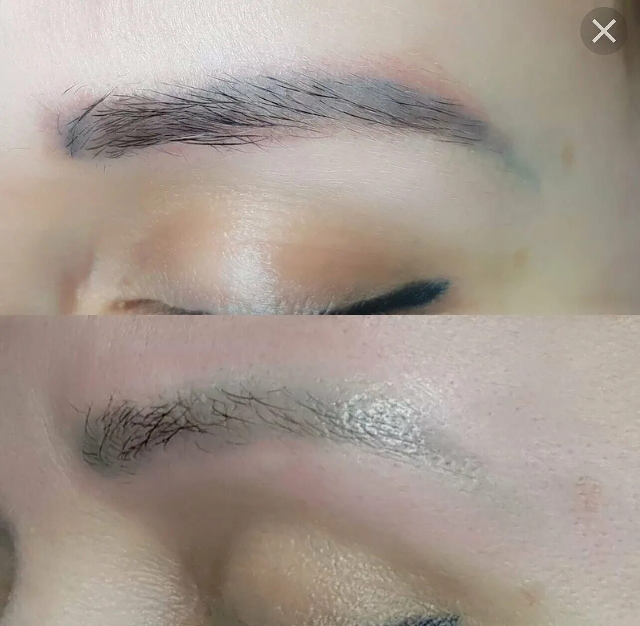 сведение татуажа ремувером до и после. сведение татуажа бровей лазером. брови после лазера. брови после удаления татуажа лазером отзывы. пигментация после лазерного удаления татуажа.