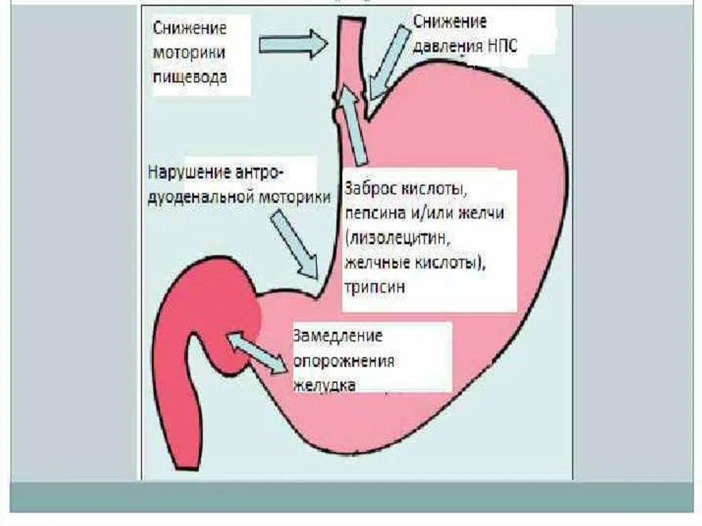 Заброс желчи в желудок и пищевод