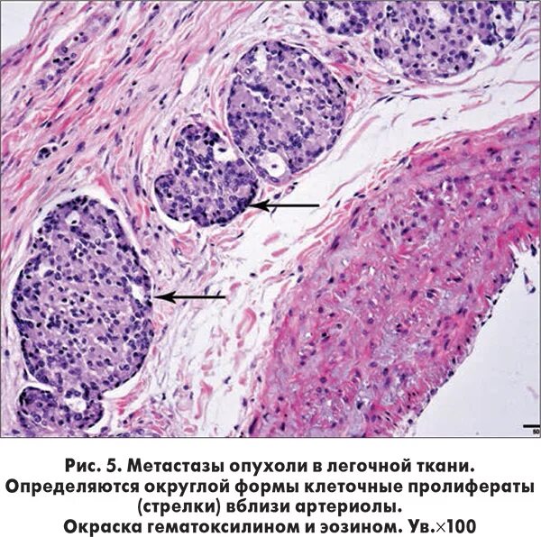 Рак молочной железы метастазы в легких. Аденокарцинома печени гистология. Хорионэпителиома гистология. Канцероматоз патологическая анатомия. Мелкоацинарная аденокарцинома гистология.