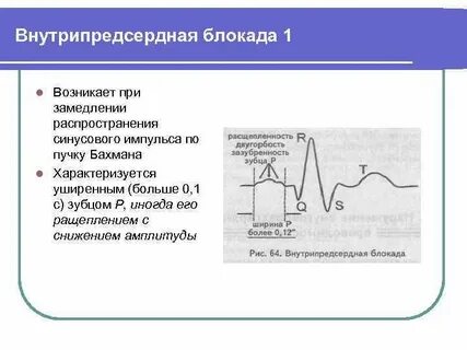 Причины замедления внутрипредсердной проводимости