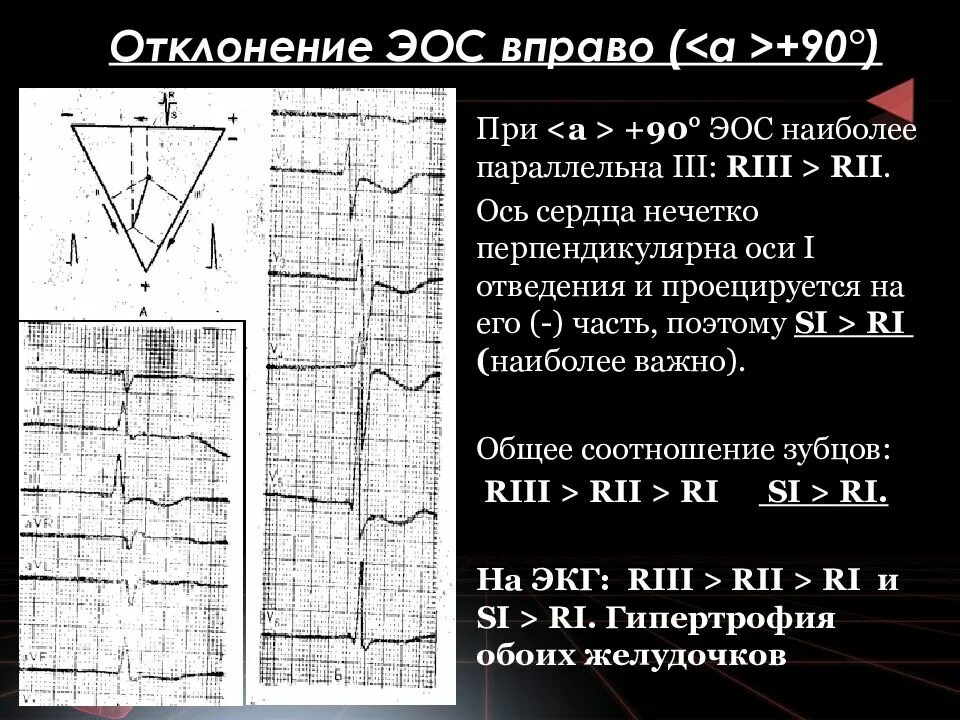 Срединное положение эос. Экг при отклонении эос вправо. отклонение электрической оси на экг. нормальное положение электрической оси на экг. показатели экг положение электрической оси сердца.