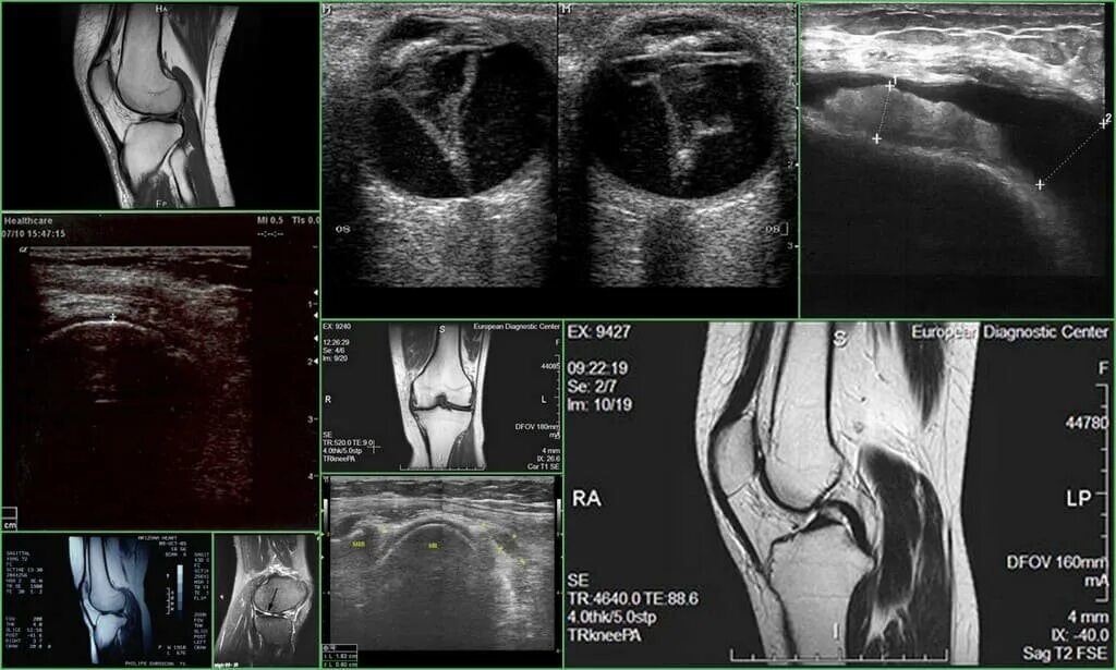 Чем отличается узи от мрт. Синовит коленного сустава на УЗИ. Магнитно-резонансная томография коленного сустава. Разрыв мениска коленного сустава на УЗИ.