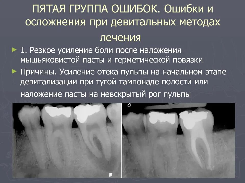 Многокорневой пульпит. Периодонтит зуба рентген. Ошибки и осложнения пульпита. Осложнения лечения пульпита