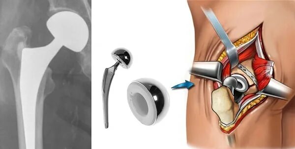 Эндопротезирование ТБС. Эндопротезирование ТБС операция. Операция эндопротез тазобедренный. Операция эндопротезирование шейки бедра. Как происходит операция по замене тазобедренного сустава