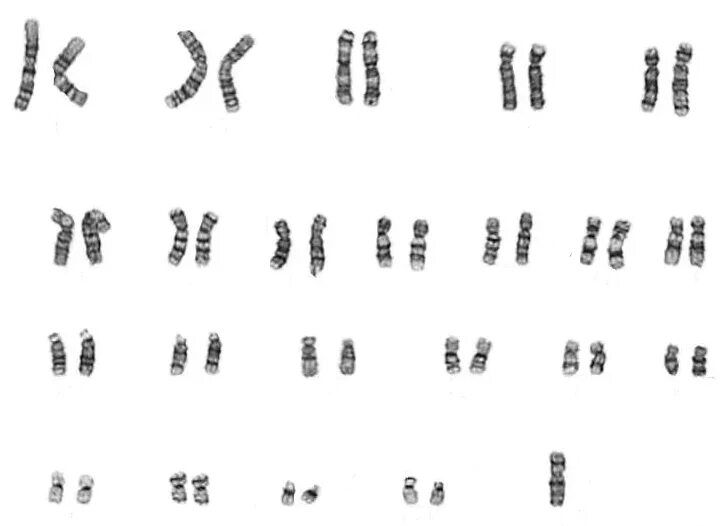 Отсутствие х хромосомы у мужчин. Кариограмма хромосом синдром. Кариограмма хромосомных заболевания. Синдром Клайнфельтера кариограмма. Кариограмма хромосом мужчины.