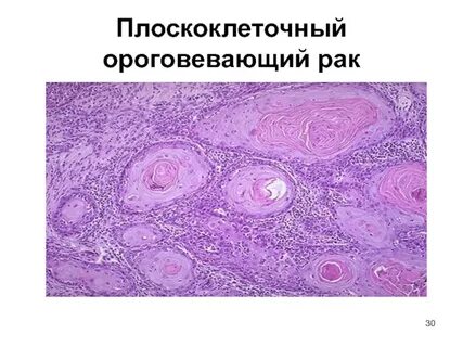 Плоскоклеточный рак легкого