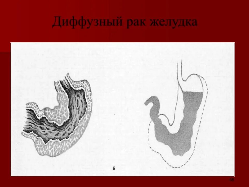 Диффузный живот. Диффузно-инфильтративная опухоль желудка. инфильтративно язвенный. диффузный и интестинальный типы опухоли желудка.