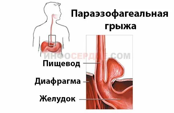 Параэзофагеальная грыжа диафрагмы. Параэзофагеальная грыжа пищеводного отверстия диафрагмы. Параэзофагеальная кишечная грыжа. Параэзофагеальный грыжа рентген Параэзофагеальная.