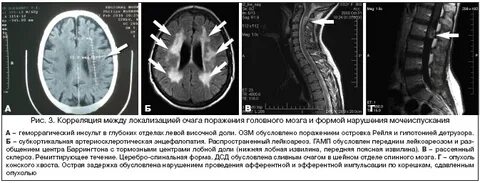 Центр мочеиспускания в головном мозге