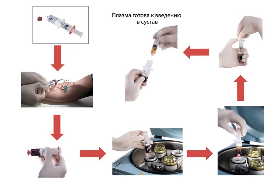 Плазмолифтинг коленного сустава. Введение обогащенной тромбоцитами плазмы в сустав. Плазма терапия для суставов что это. Плазмолифтинг суставов что это