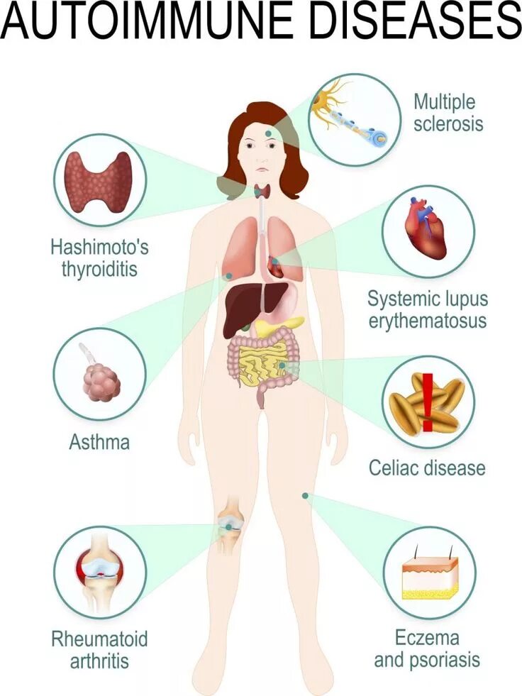 Аутоиммунные заболевания. Autoimmune disease. Иммунная система человека. Эндокринология картинки. Autoimmune disease.