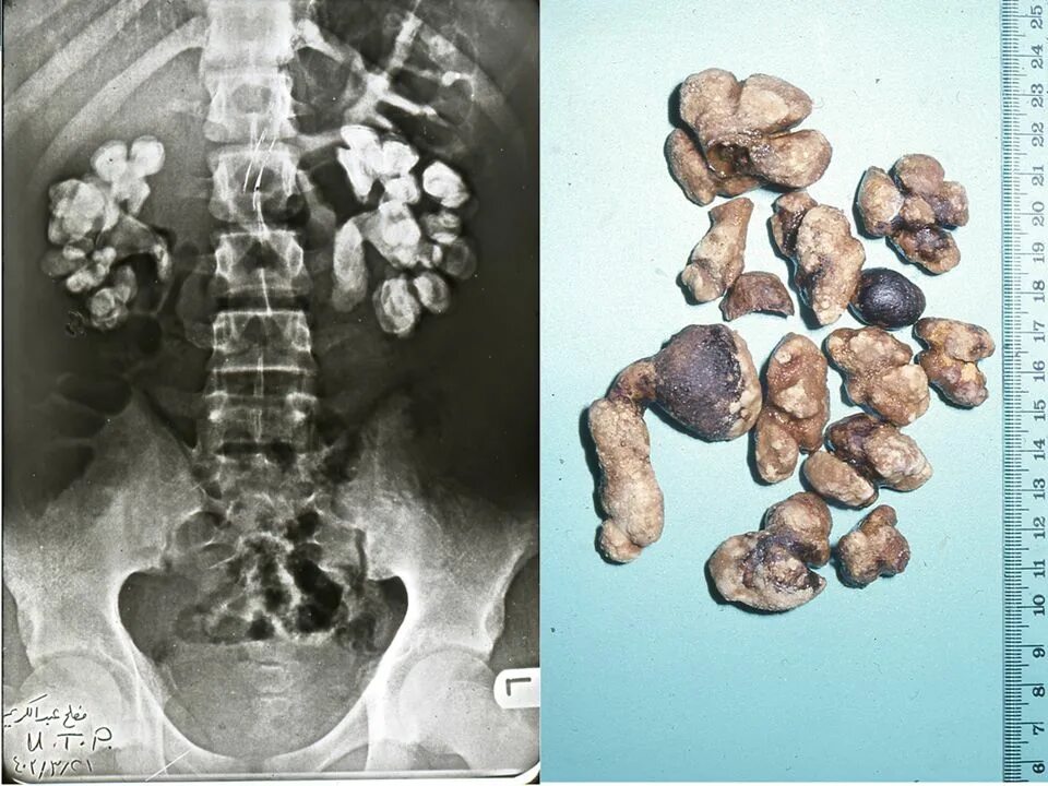 Мочекаменная болезнь коралловидные камни. Мочекаменная болезнь (нефролитиаз). Коралловидный нефролитиаз. Коралловидный камень в почке рентген.