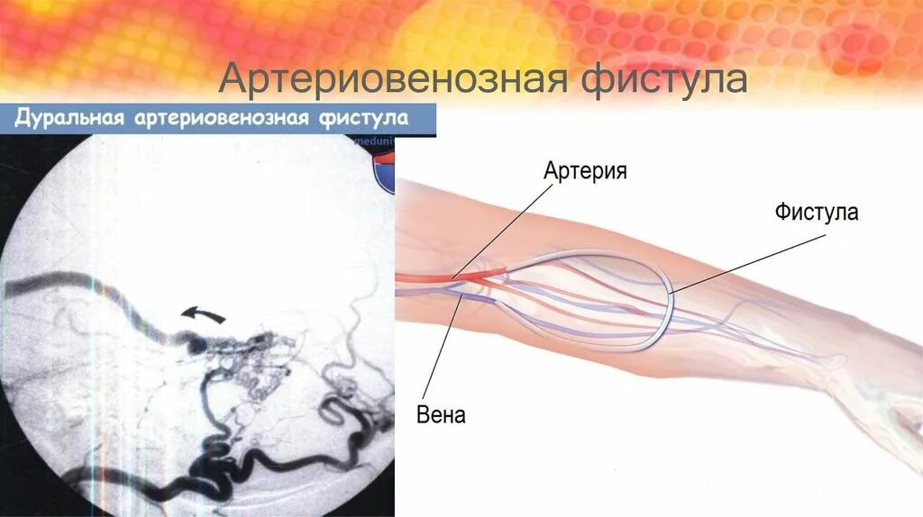 Фистула. Артериовенозная фистула. Артерио-венозная фистула. Аретерио венозная фистула. Артер овенозная фистула.