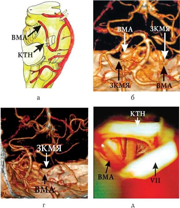 Мрт лицевого нерва. Тройничный нерв мрт анатомия. Нейроваскулярный конфликт тройничного нерва. Нейроваскулярная декомпрессия тройничного нерва. Нейроваскулярный конфликт мрт анатомия.