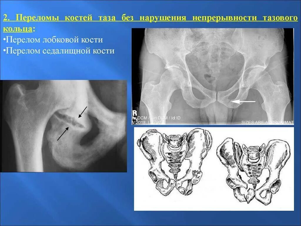 Краевые переломы костей таза рентген. Перелом лонной кости рентген. Краевой перелом таза рентген. Перелом костей таза рентгенограмма.