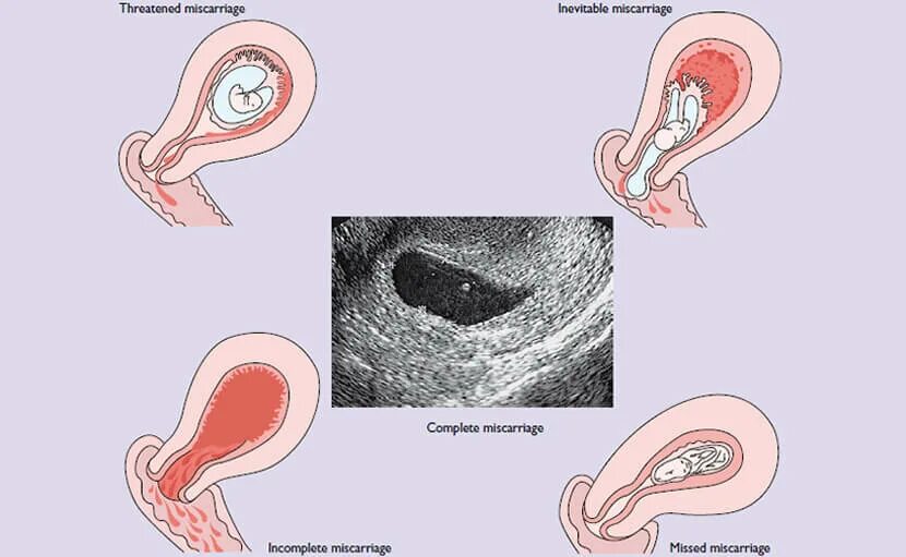 Через сколько месячные после медикаментозного прерывания. Самопроизвольный аборт. Начавшийся самопроизвольный аборт. Стадии самопроизвольного аборта. После медикаментозного прерывания.