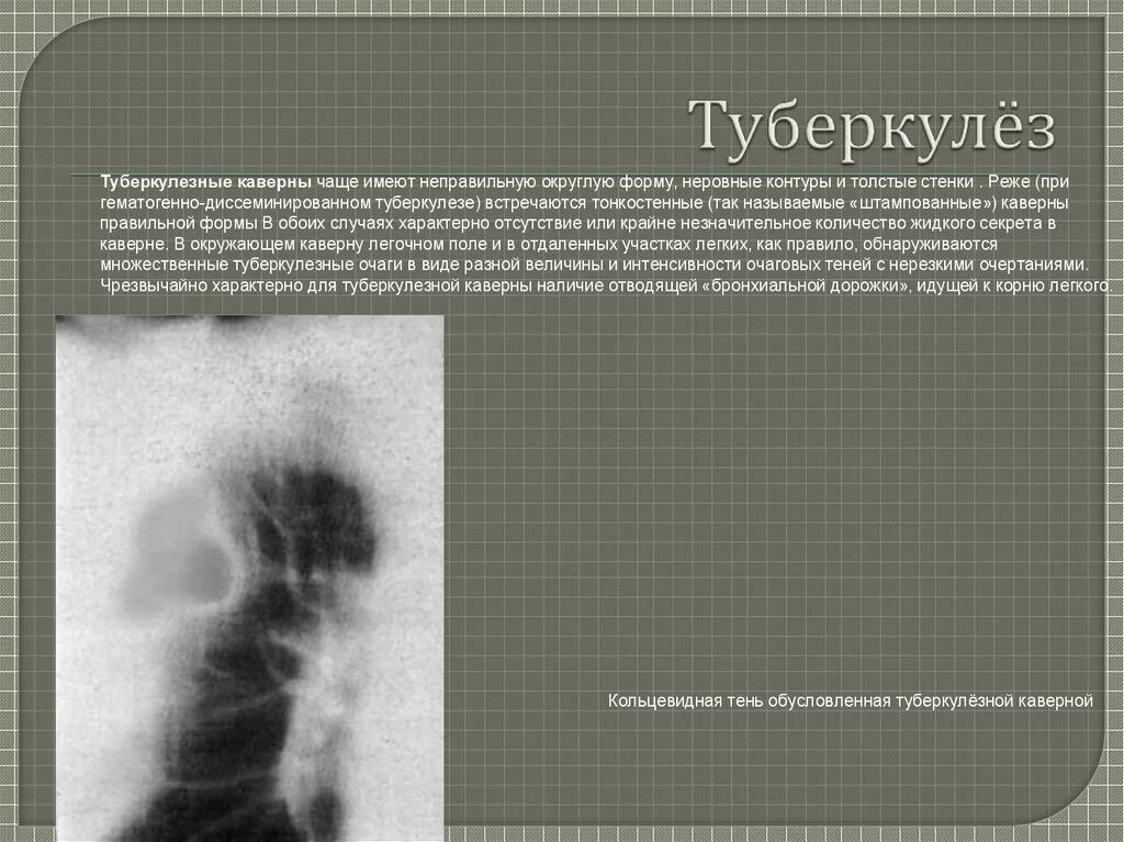 Штампованные каверны туберкулез. Штампованные каверны при диссеминированном туберкулезе. Штампованные каверны характерны для туберкулеза. Кавернозный туберкулез тень.