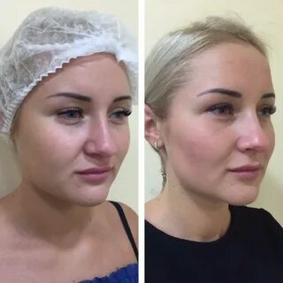 Липолитики для лица москва