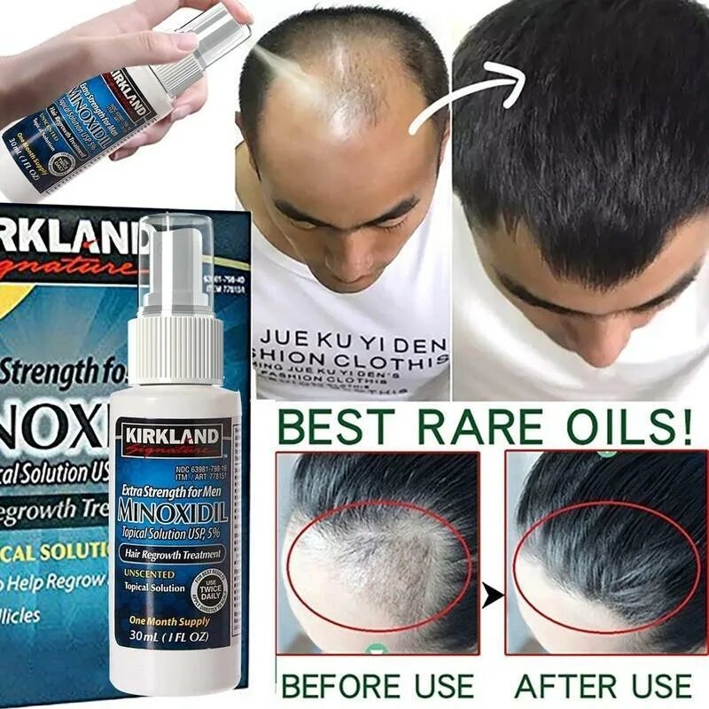 Миноксидил 5 для волос. Minoxidil Kirkland 5% hair. Minoxidil Kirkland миноксидил 5% 60 мл. Миноксидил для волос для мужчин 15%.