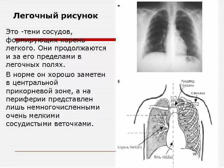 Усиление легочного рисунка. Легочной рисунок рисунок. Легочный рисунок в норме. Легочный рисунок обеднен. Корень легкого уплотнен что значит