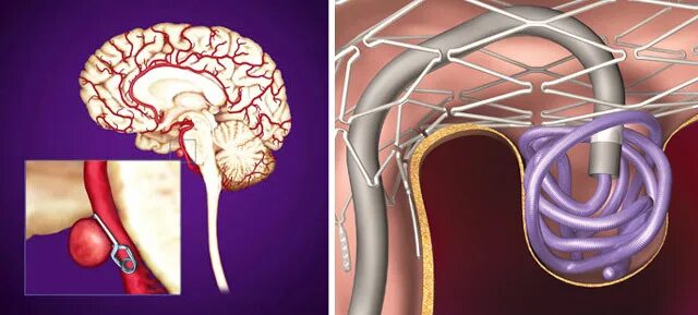 Аневризма стент. Эндоваскулярная аневризма головного мозга. Эндоваскулярная операция аневризмы головного. Клипирование аневризмы сосудов головного мозга. Эндоваскулярная операция аневризмы сосудов головного мозга.