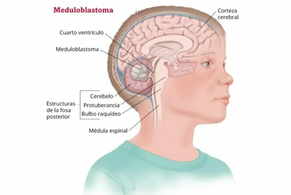 Опухоль головного мозга мозжечка. Опухоль головного мозга у ребенка. Объёмное образование головного мозга задней черепной ямки. Опухоли мозга у подростков