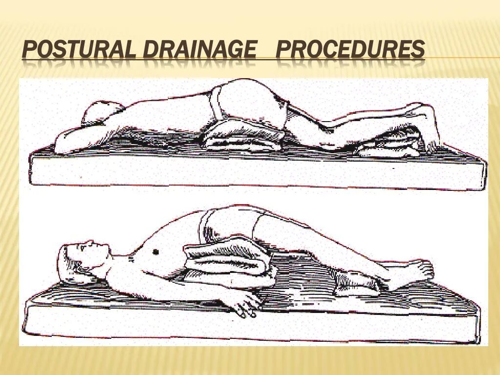Операция лежа на животе. Позиционный (Постуральный) дренаж. Постуральный дренаж при бронхите. Постуральный дренаж при пневмонии. Позиционный Постуральный дренаж алгоритм.