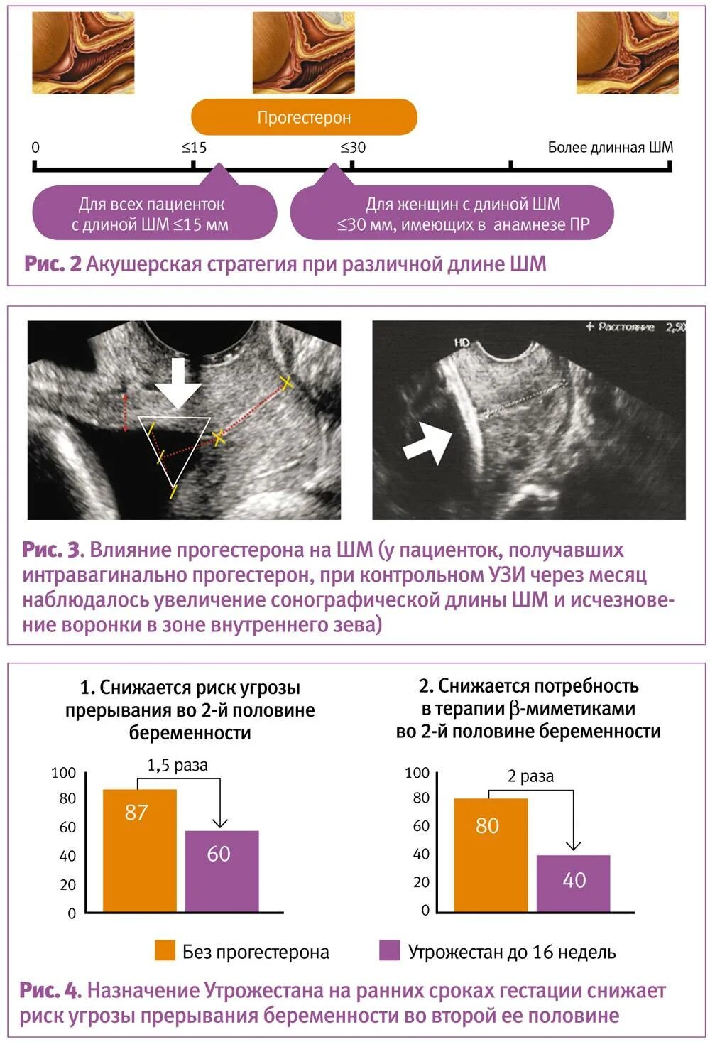 Короткая шейка при беременности. Утрожестан в разрезе. Действие утрожестана при беременности. Воздействие утрожестана на шейку матки.