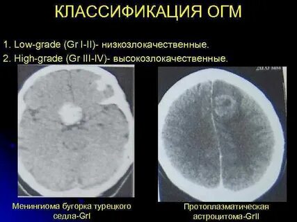 Рак grade 3