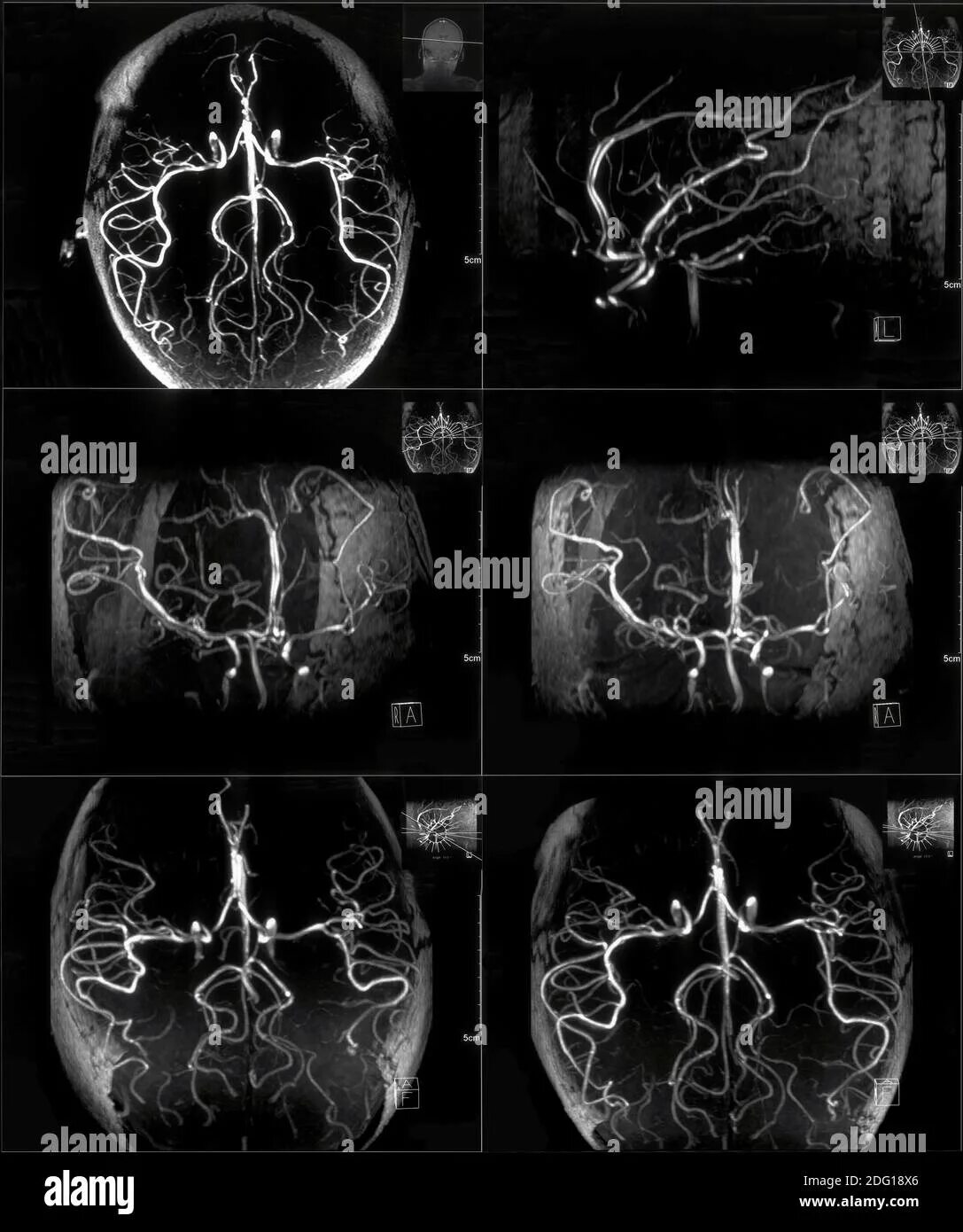 Мрт сосудов головного мозга (мрт-ангиография). Кт ангиография сосудов головного мозга. Кт ангиография сосудов шеи.