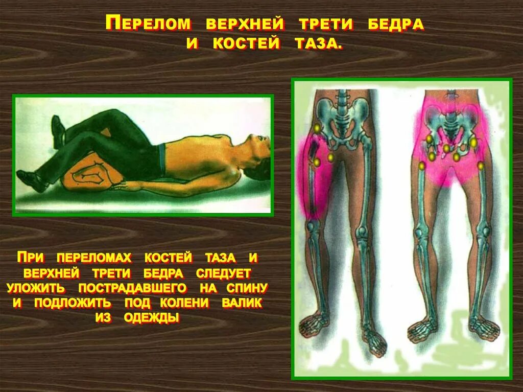 средняя треть бедренной кости. вертельный перелом кости вертельный бедренной кости. седалищный нерв малоберцовый нерв. первая треть бедра. первая треть бедра.